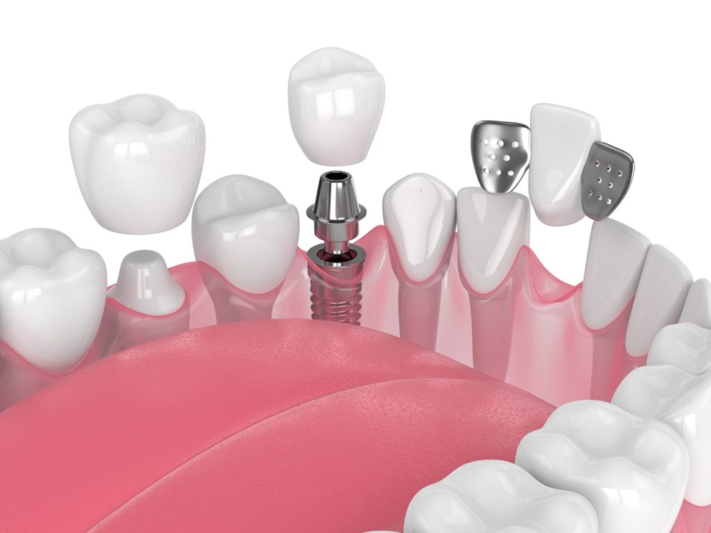 Cirugía Bucal e Implantes - BF Estetica Dental - Tecnología al alcance de todos